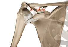 Acromioclavicular Joint Dislocation