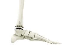 Ankle Joint Replacement