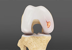 Chondral (Articular Cartilage Defects)