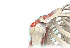 Calcific Tendonitis