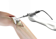 Computer Navigation for Total Knee Replacement