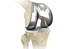 Custom-fitted Total Knee Arthroplasty