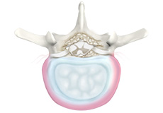 Degenerative Spine Disease