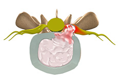 Disc Herniation