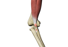 Distal Biceps Rupture