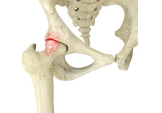 Femoroacetabular Impingement