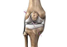 Knee Ligament Reconstruction