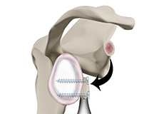 Latarjet Procedure