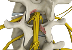 Spinal Decompression