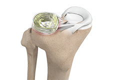 Meniscus Replacement