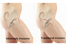 Minimally Invasive Total Hip Replacement