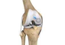 Osteochondritis Dissecans