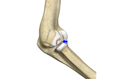 Osteochondritis Dissecans of the Capitellum