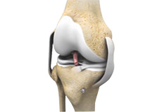 Revision Ligament Reconstruction