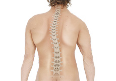 Scoliosis