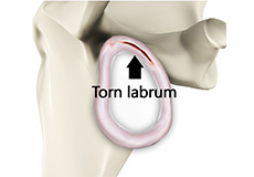 Shoulder Labrum Tear