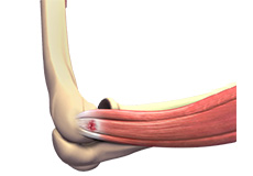 Tennis Elbow (Lateral Epicondylitis)