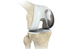 Minimally Invasive Knee Replacement